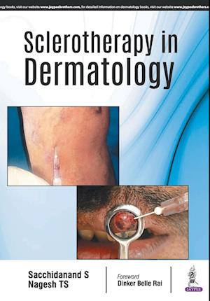 Sclerotherapy in Dermatology