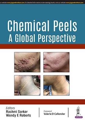 Chemical Peels: A Global Perspective