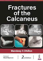 Fractures of the Calcaneus 