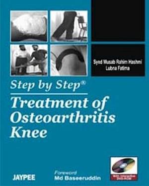 Step by Step: Treatment of Osteoarthritis Knee