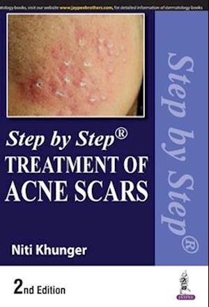 Step by Step Treatment of Acne Scars