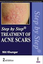 Step by Step Treatment of Acne Scars 