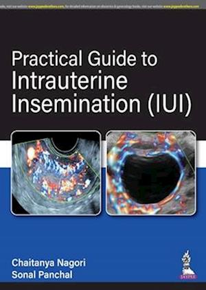 Practical Guide to Intrauterine Insemination (IUI)