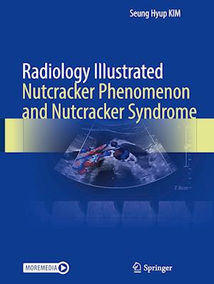 Radiology Illustrated: Nutcracker Phenomenon and Nutcracker Syndrome