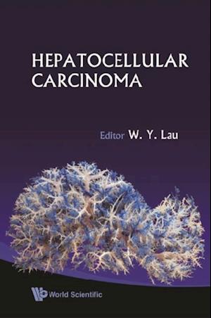 Hepatocellular Carcinoma