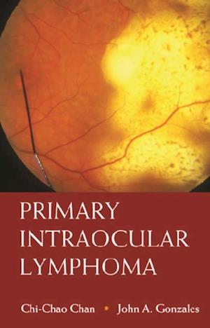 Primary Intraocular Lymphoma