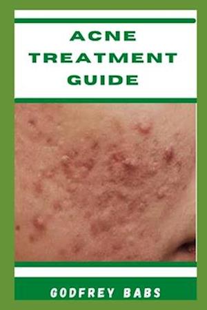 Acne Treatment Guide