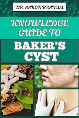 Knowledge Guide to Baker's Cyst