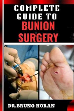 Complete Guide to Bunion Surgery