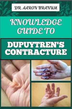 Knowledge Guide to Dupuytren's Contracture