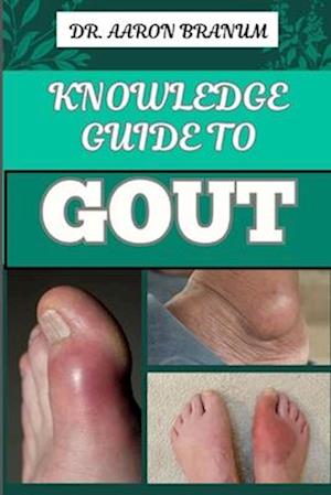 Knowledge Guide to Gout