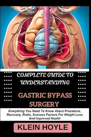 Complete Guide to Understanding Gastric Bypass Surgery