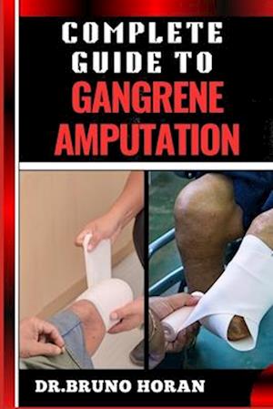 Complete Guide to Gangrene Amputation