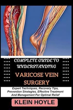 Complete Guide to Understanding Varicose Vein Surgery