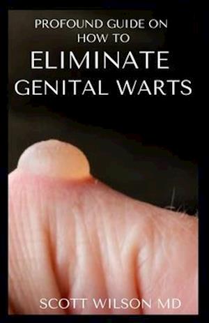 Profound Guide to Eliminate Genital Warts