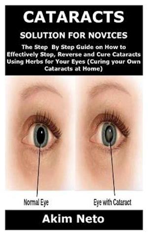 Cataracts Solution for Novices