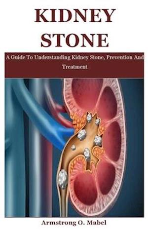 Kidney Stone: A Guide To Understanding Kidney Stone, Prevention And Treatment