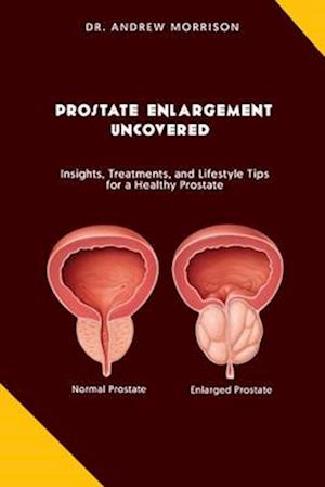 PROSTRATE ENLARGEMENT UNCOVERED : Insights, Treatments, and Lifestyle Tips for a Healthy Prostate