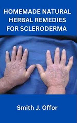 HOMEMADE NATURAL HERBAL REMEDIES FOR SCLERODERMA