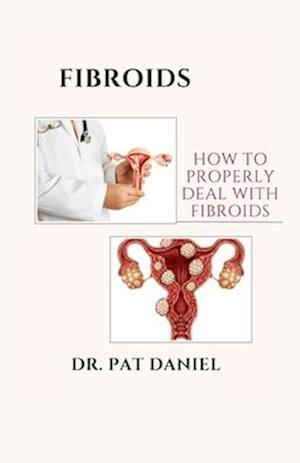 FIBROIDS: HOW TO PROPERLY DEAL WITH FIBROIDS